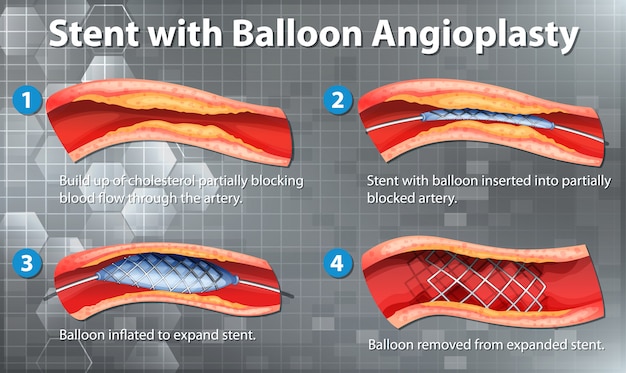 Vascular Stents: Revolutionizing the Treatment of Coronary Artery Disease (CAD)